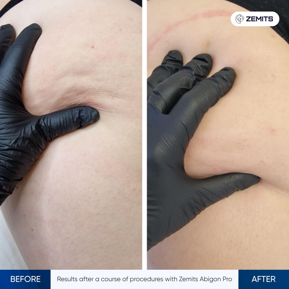 Before and after example showing skin texture